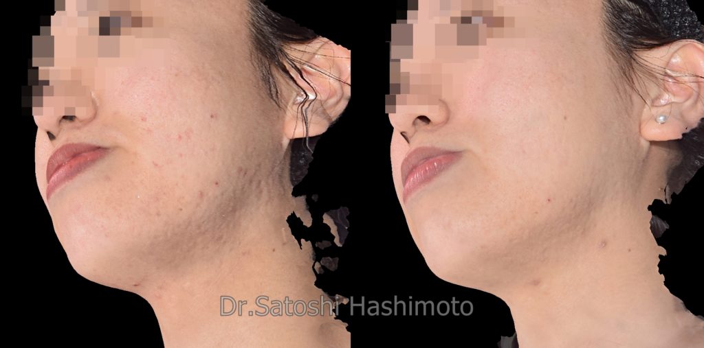 ニキビ跡治療にはダーマペン４が現状では最高峰 美容皮膚科 美容外科 医師 橋本聡 Official Homepage