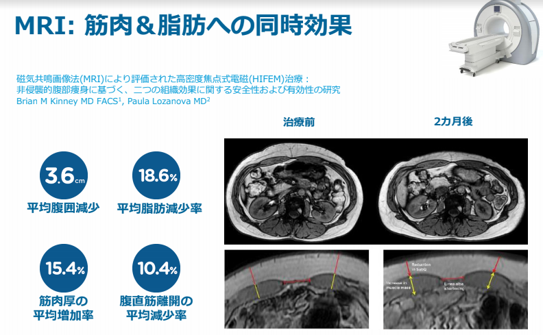 超短期間で筋肉増大＆脂肪除去を可能にした夢のマシン『エムスカルプト  