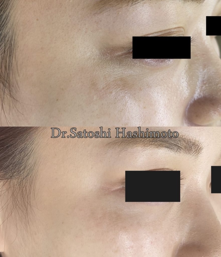 スネコス Sunekos とダーマペン４は理想的な組み合わせ スキンフィニティクリニック